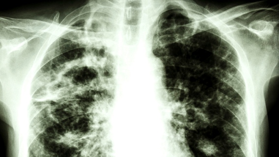 Tuberculose: Plus mortelle que le Covid