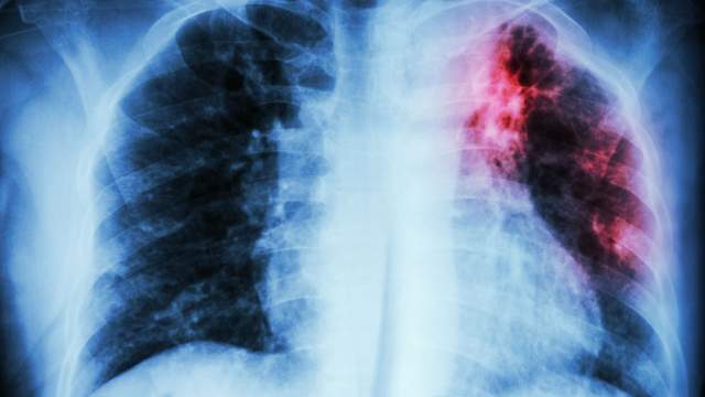 Tuberculose : 1,5 millions de morts en 2020